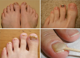 Signs of nail fungus