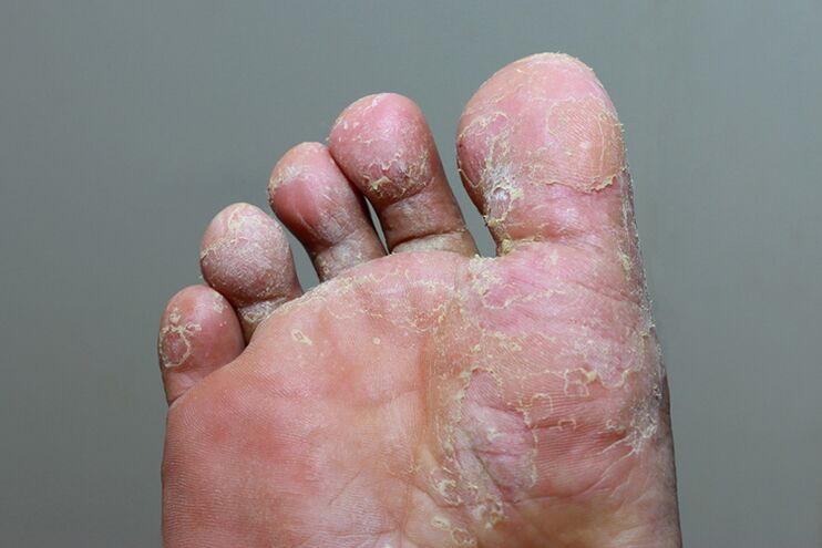 severe stage of ringworm of the toe skin