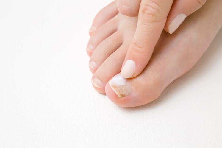toe treatment with fungal ointment