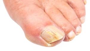 what is nail fungus