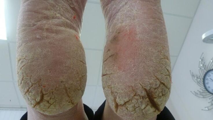 foot fungus manifestations