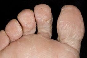 fungal symptoms on the skin of the feet