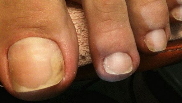 Signs of the early stage of nail fungus