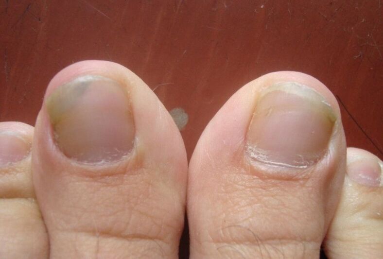 The early stage of nail fungus
