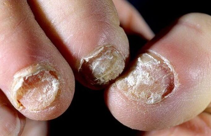 advanced nail fungus