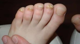 Affected by fungus, almost all toes