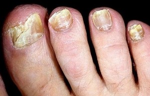 Nails crumble from fungus