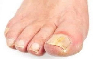 The initial stage of fungus on the toenails