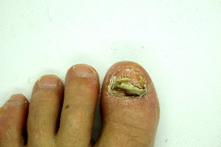 Fungus on the finger nails – the heavy stage